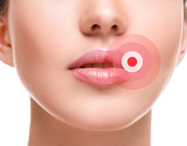 herpes na ustnicah